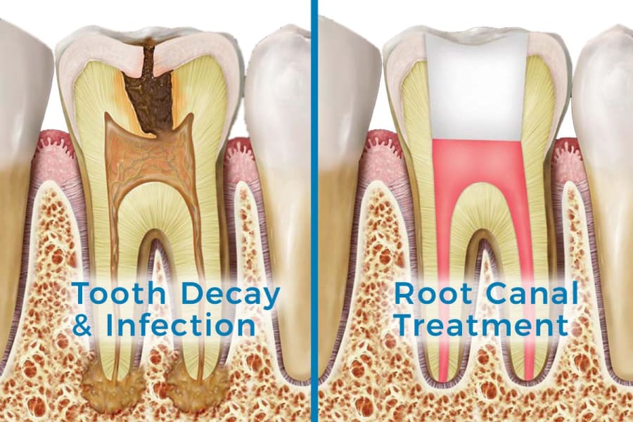 root canal dentist maple ridge